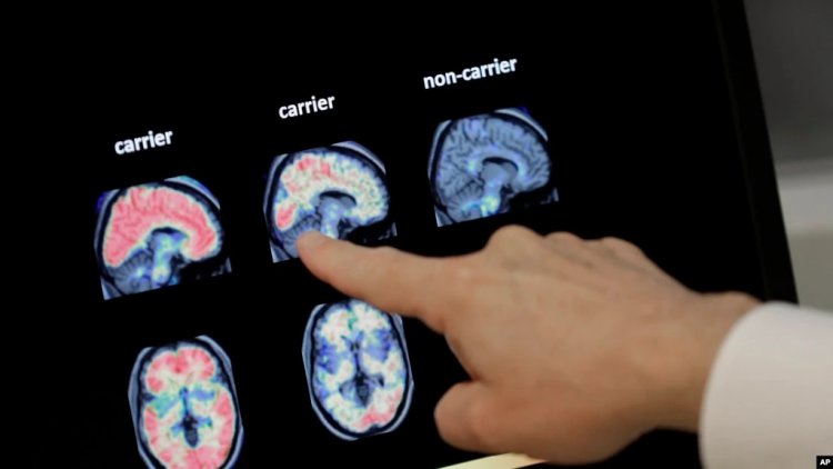 Yeni Alzheimer İlacının Yan Etkileri Tartışma Konusu